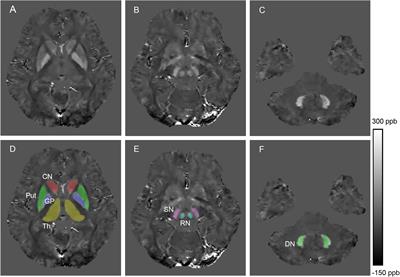 Paramagnetic Metal Accumulation in the Deep Gray Matter Nuclei Is Associated With Neurodegeneration in Wilson’s Disease